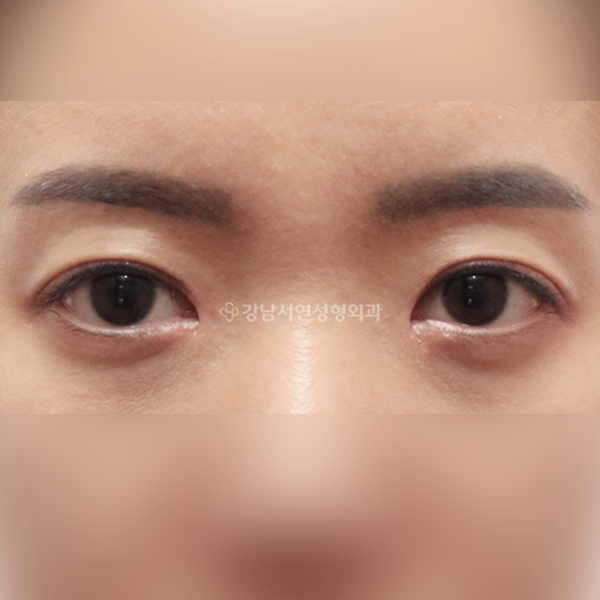 절개 쌍꺼풀 재수술 AFTER