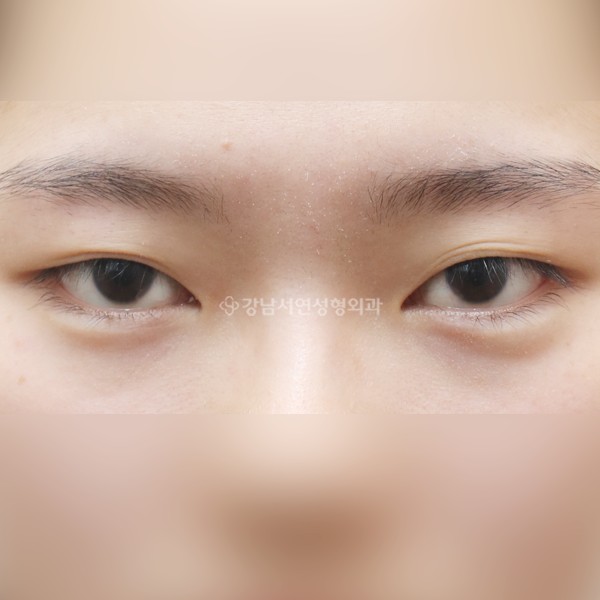 절개눈매교정 재수술 BEFORE