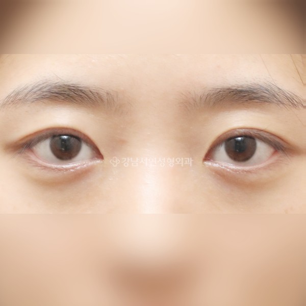 절개눈매교정 재수술 AFTER