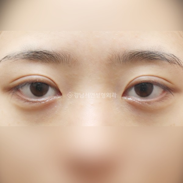 절개눈매교정 재수술 BEFORE