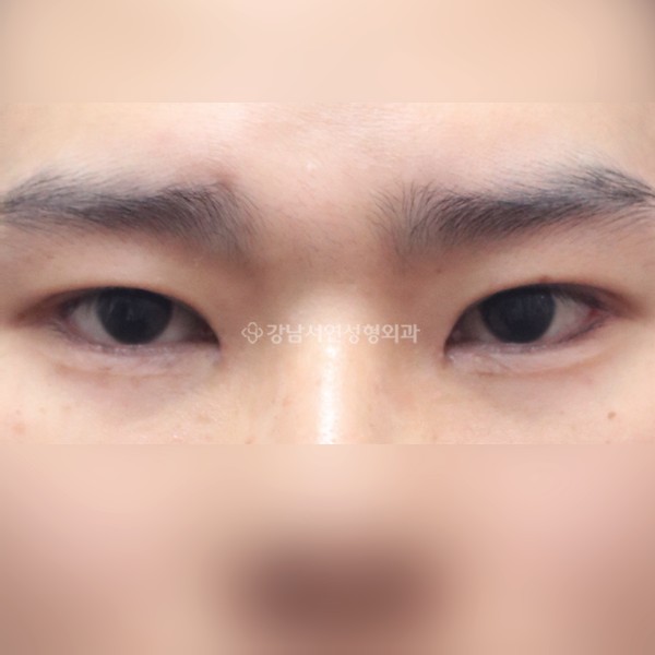 절개눈매교정+앞트임+뒷트임+밑트임 AFTER