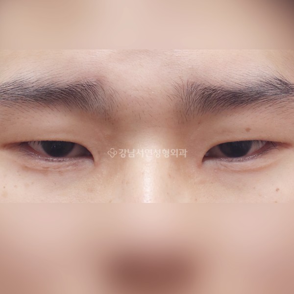 절개눈매교정+앞트임+뒷트임+밑트임 BEFORE
