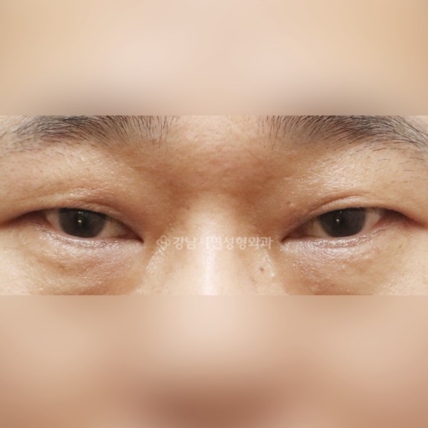 절개눈매교정+뒷트임+밑트임 BEFORE