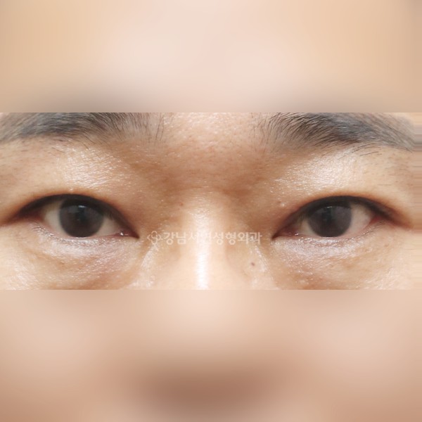 절개눈매교정+뒷트임+밑트임 AFTER