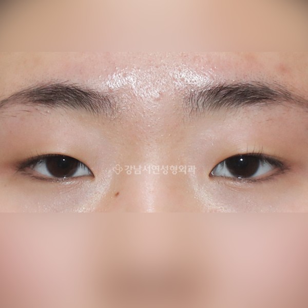절개눈매교정+앞트임+뒷트임+밑트임 BEFORE