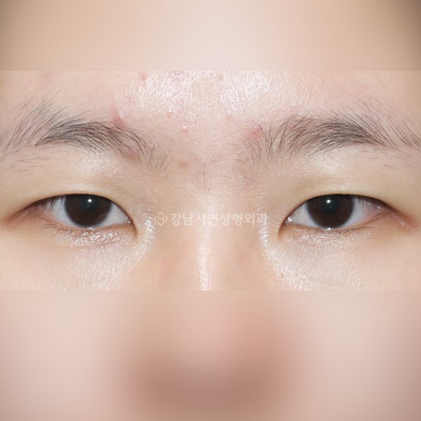 절개눈매교정+앞트임+뒷트임+밑트임 BEFORE