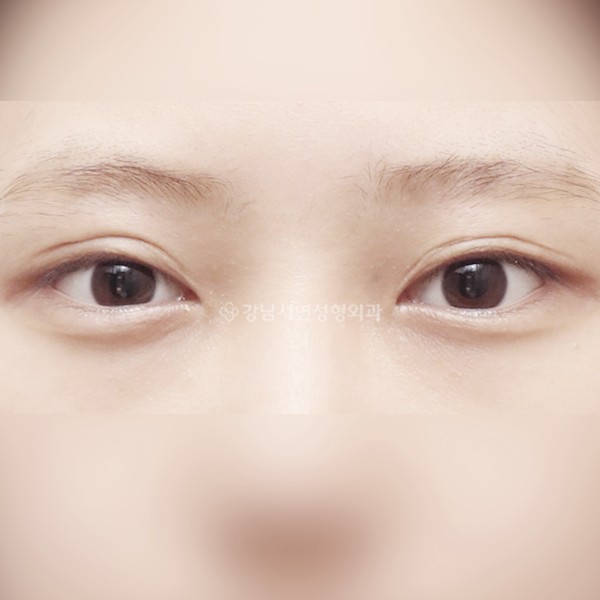 절개눈매교정 재수술 BEFORE