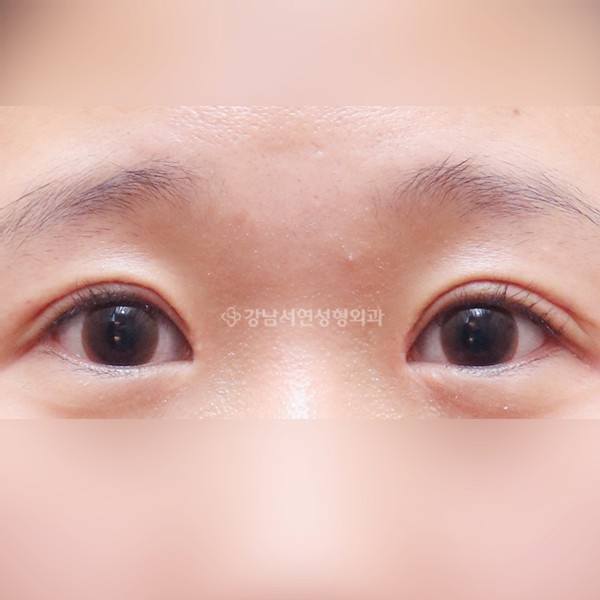 절개눈매교정 재수술 AFTER