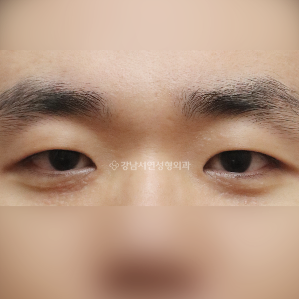 절개눈매교정+앞트임 BEFORE