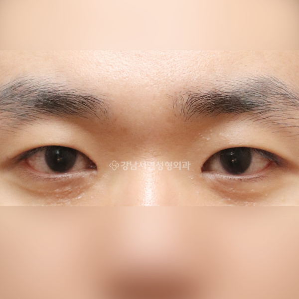 절개눈매교정+앞트임 AFTER