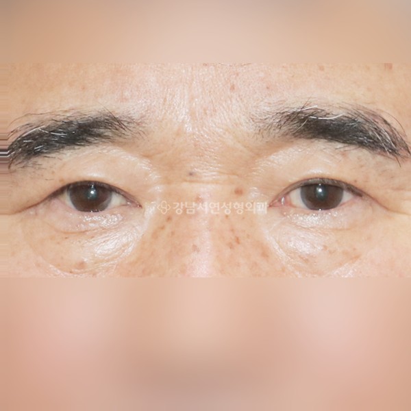 상안검 AFTER