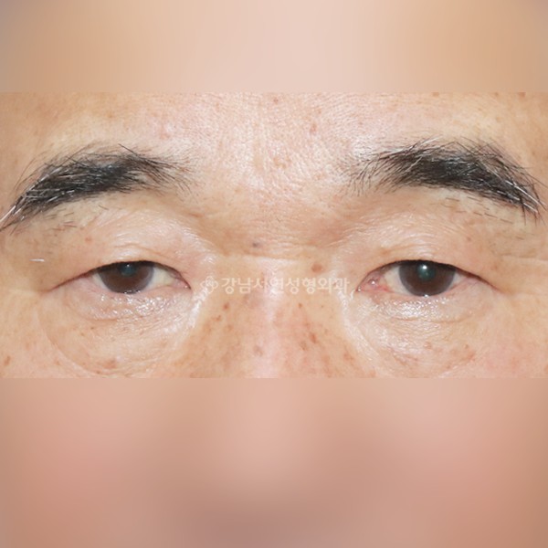 상안검 BEFORE
