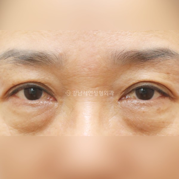 하안검 BEFORE