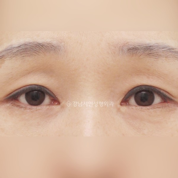 상안검 + 하안검 + 앞트임 + 밑트임 AFTER