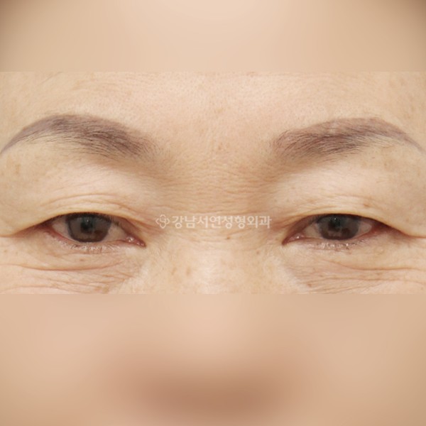 상안검 BEFORE