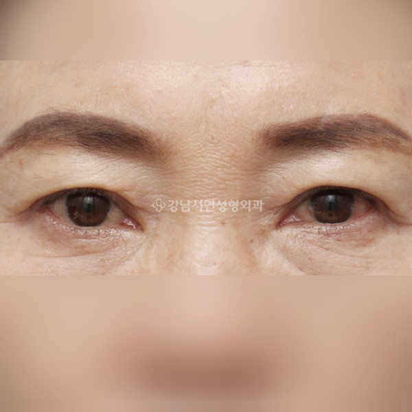 상안검 AFTER