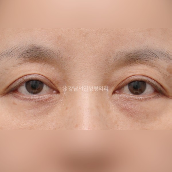 상안검 + 하안검 AFTER