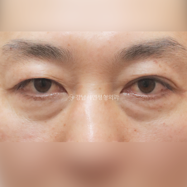하안검 BEFORE