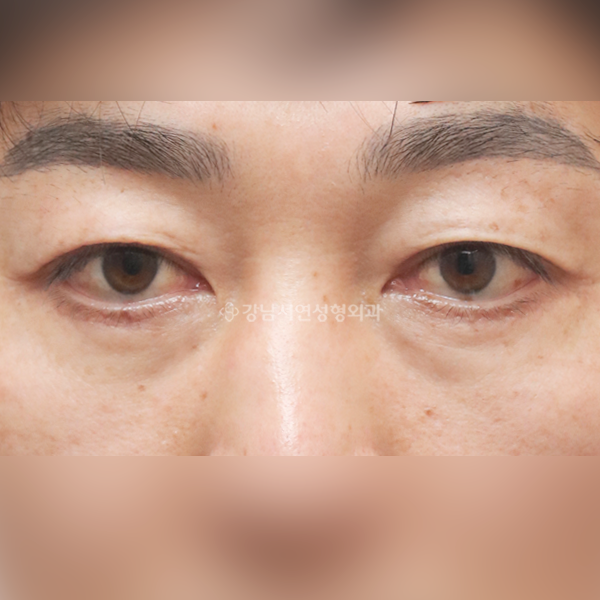 하안검 AFTER