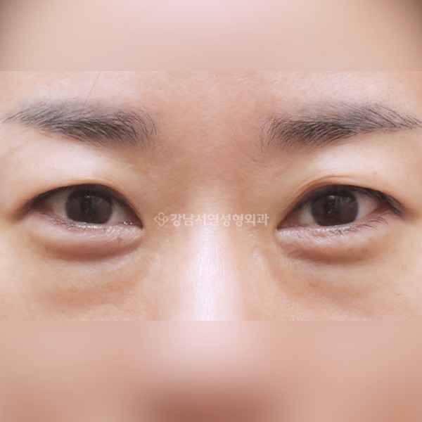 눈밑지방재배치 BEFORE