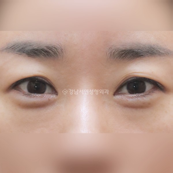 눈밑지방재배치 AFTER