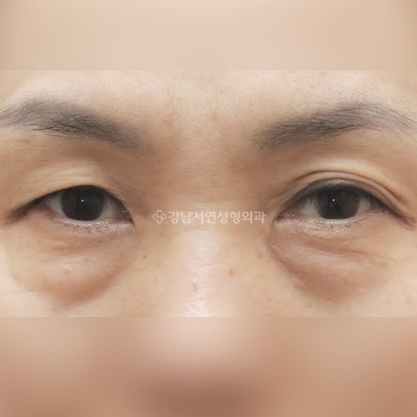 상안검 + 하안검 + 앞트임 BEFORE