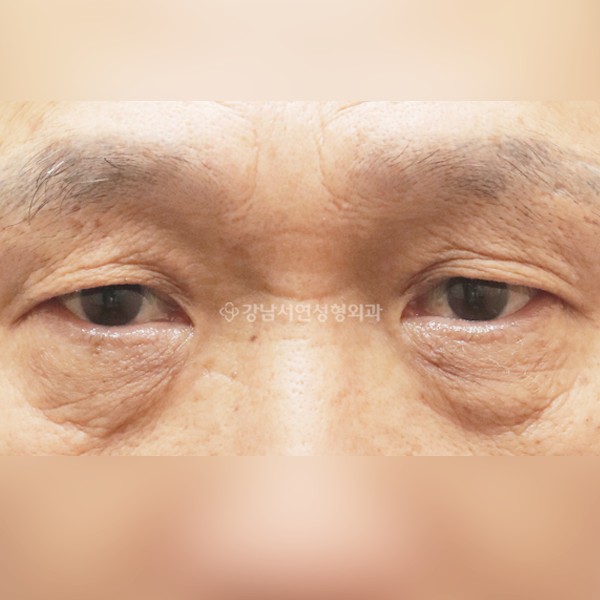 상안검 + 하안검 BEFORE
