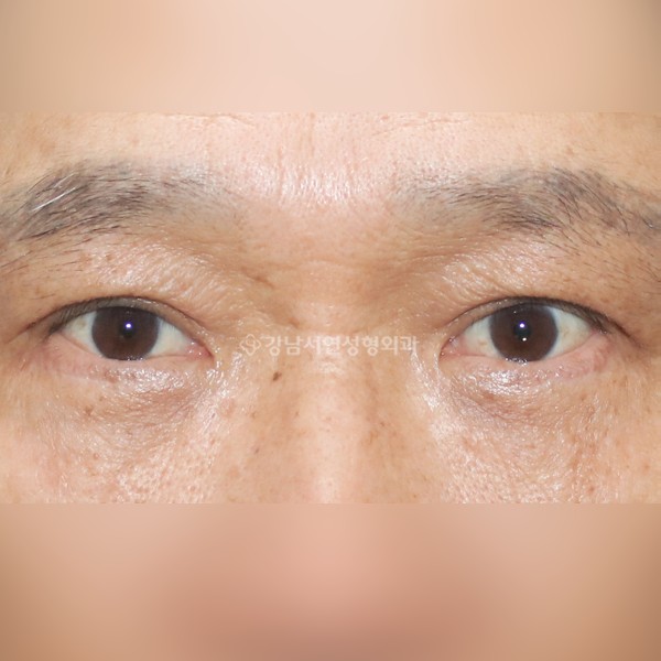 상안검 + 하안검 AFTER