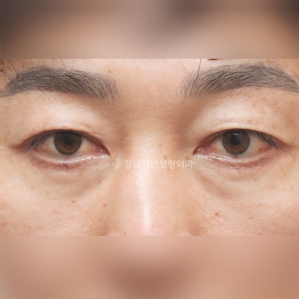 하안검 AFTER