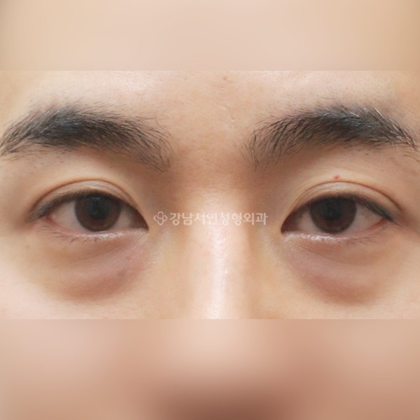 눈밑지방재배치 BEFORE