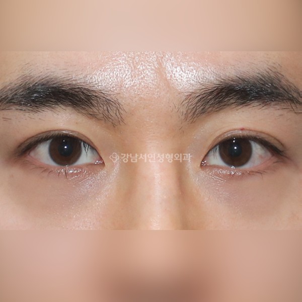 눈밑지방재배치 AFTER