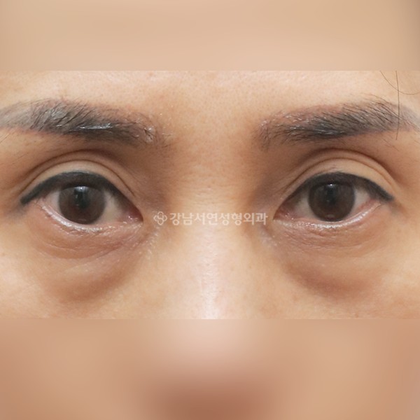 하안검 BEFORE