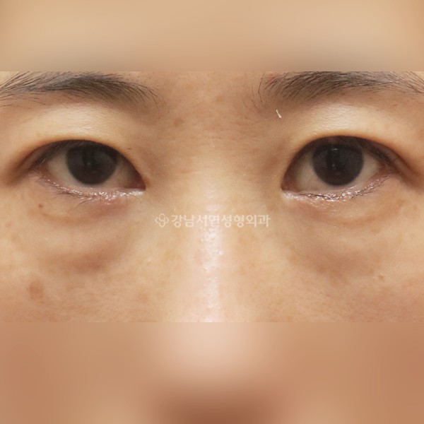 눈밑지방재배치 BEFORE