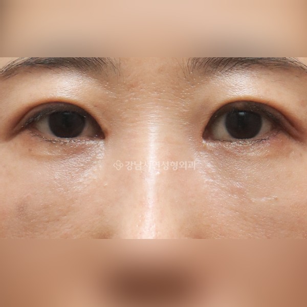 눈밑지방재배치 AFTER