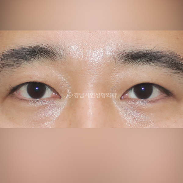 절개눈매교정 AFTER