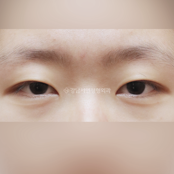 절개눈매교정+앞트임 BEFORE