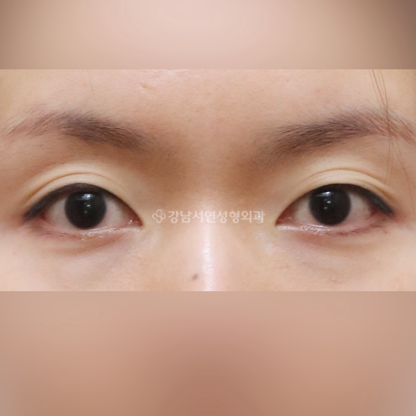 절개눈매교정 BEFORE