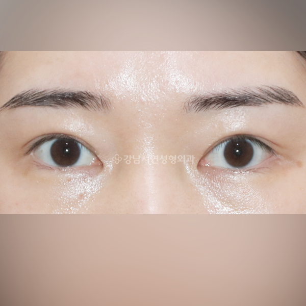 절개쌍꺼풀 재수술 AFTER
