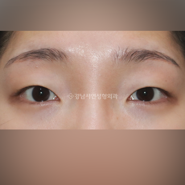 자연유착 쌍꺼풀 BEFORE