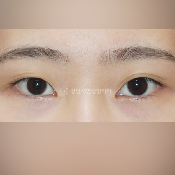 자연유착 쌍꺼풀 BEFORE