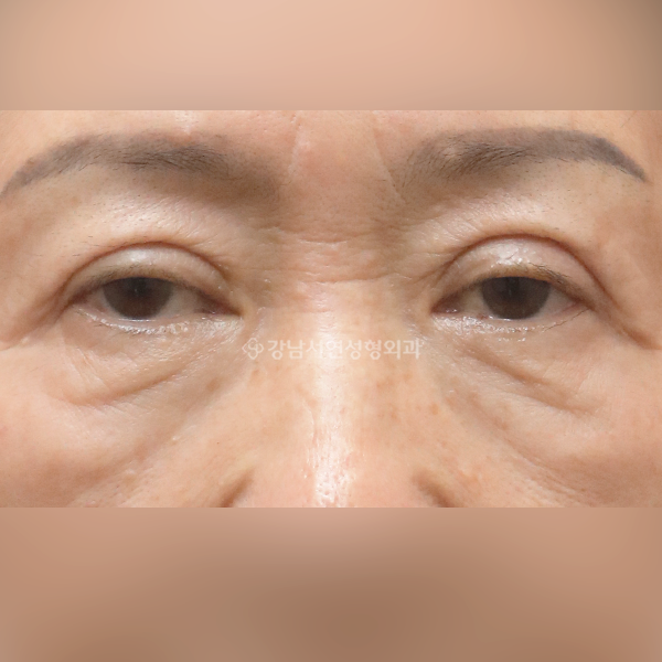 상안검 재수술+눈밑지방재배치 BEFORE