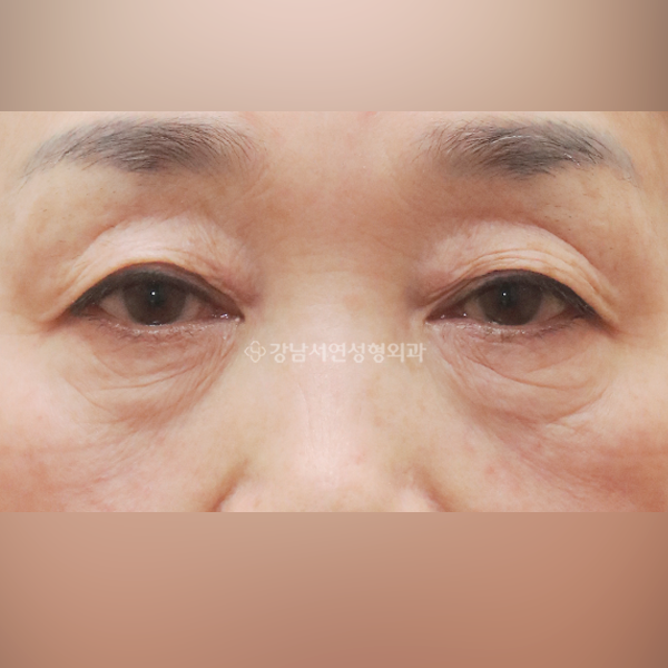 상안검+눈밑지방재배치 BEFORE