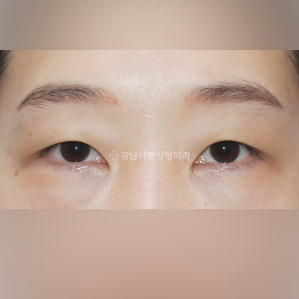 매몰쌍꺼풀 + 뒤트임 + 밑트임 BEFORE
