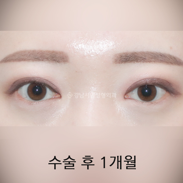 안검퇴축, 절개 쌍꺼풀 재수술 AFTER