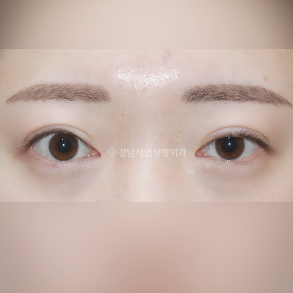 안검퇴축, 절개 쌍꺼풀 재수술 BEFORE