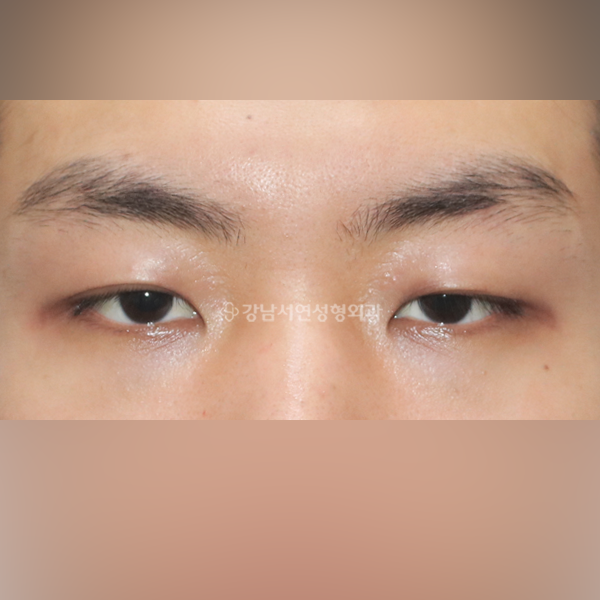 절개눈매교정 BEFORE