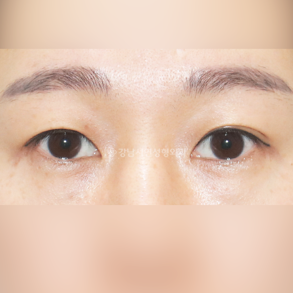 상안검+앞트임 BEFORE