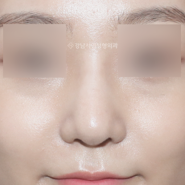 여자코성형 AFTER