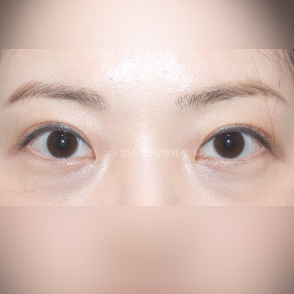 두줄따기+라인바꾸기 AFTER