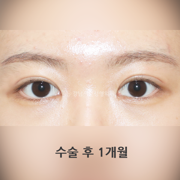 짝눈교정+앞트임 AFTER